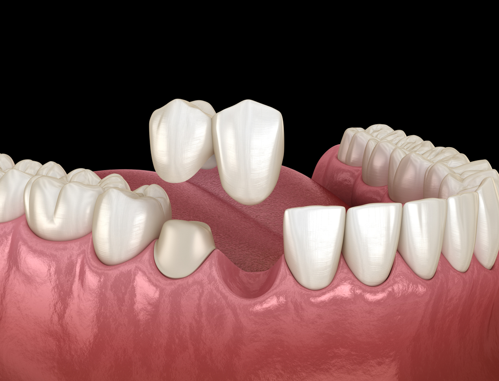 3d mnodel of cantilever dental bridge