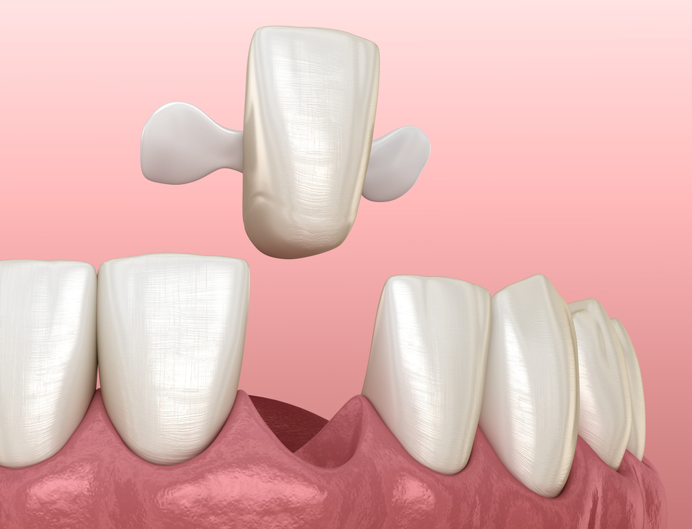 3d model of a maryland dental bridge